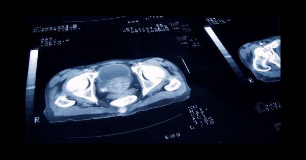 Most cancers Du Pancreas Chez Les Jeunes