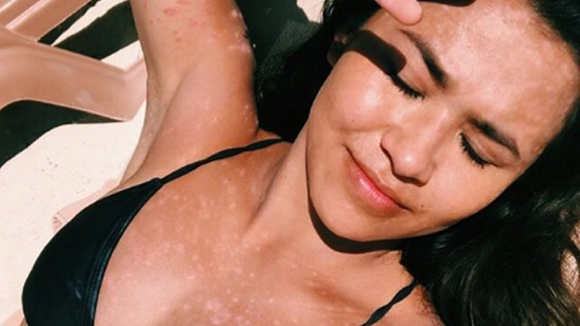 Elle partage des photos de son psoriasis et inspire Internet