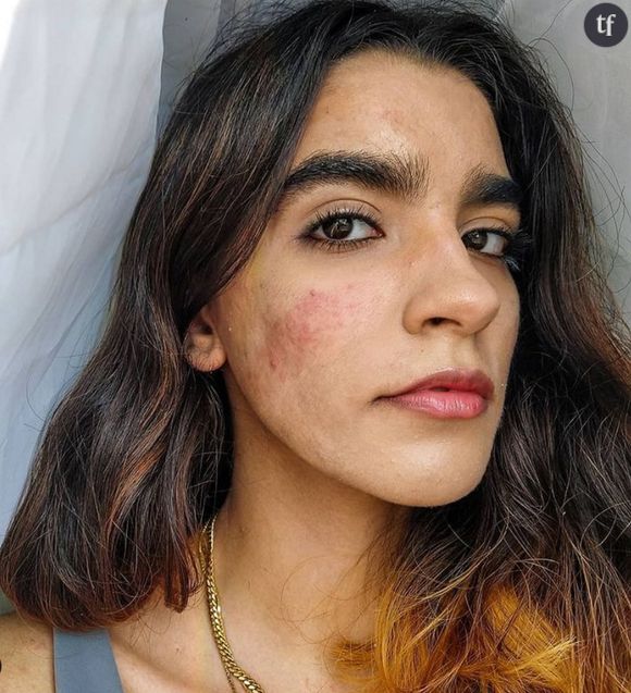 Constanza Concha, la jeune femme qui milite pour l'acceptation de l'acné (@skinnoshame)