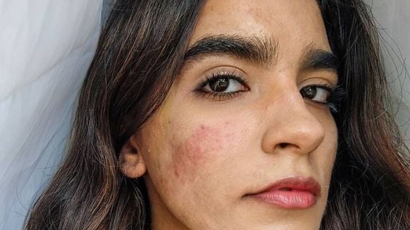 Constanza Concha, l'activiste qui milite pour l'acceptation de l'acné