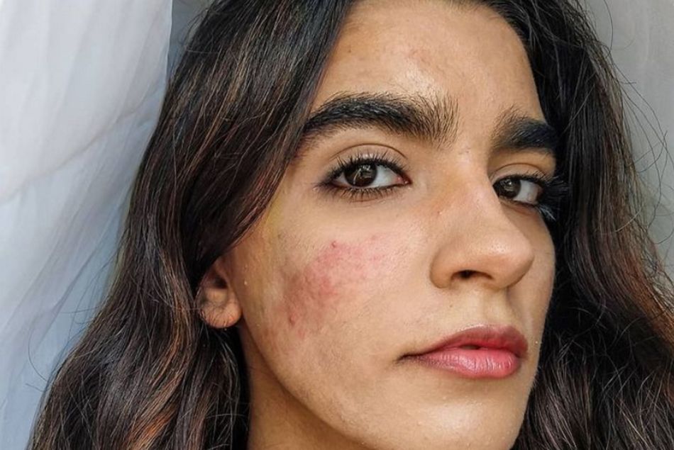 Constanza Concha, la jeune femme qui milite pour l'acceptation de l'acné (@skinnoshame)