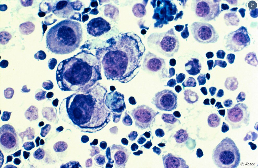 Des cellules cancéreuses