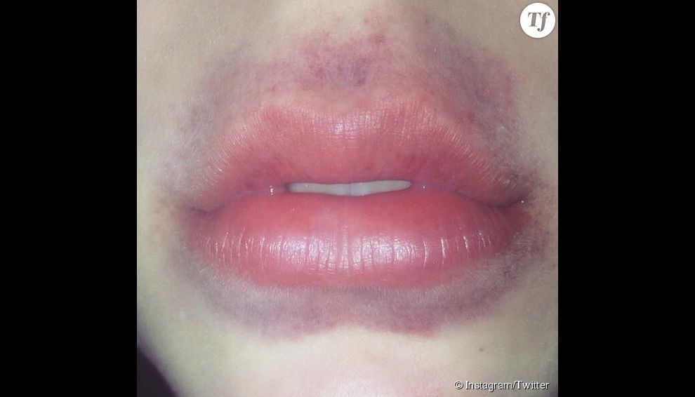 Kylie Jenner Challenge : les lèvres sont gonflées de gaçon grotesque pour ressembler à celles de Kylie Jenner