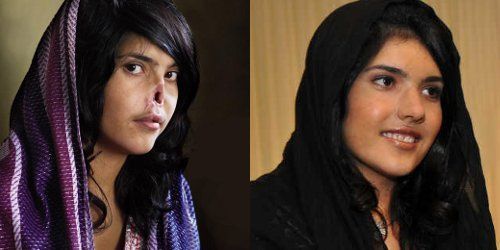 Aisha Mohammadzai dévoile son nouveau nez après sa mutilation