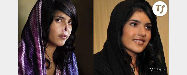 Aisha Mohammadzai dévoile son nouveau nez après sa mutilation
