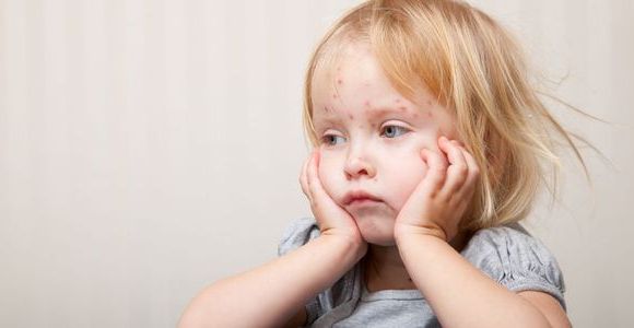 Varicelle : faut-il se faire vacciner ou vacciner son enfant ? 