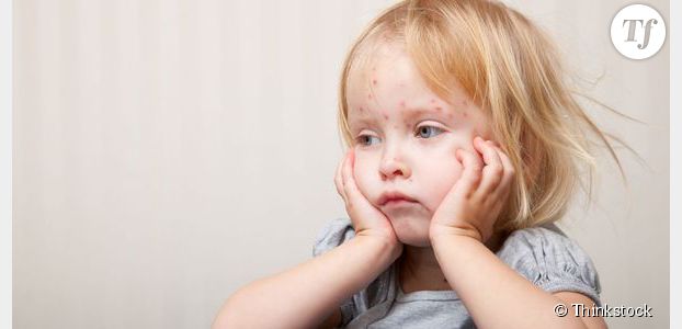 Varicelle : faut-il se faire vacciner ou vacciner son enfant ? 