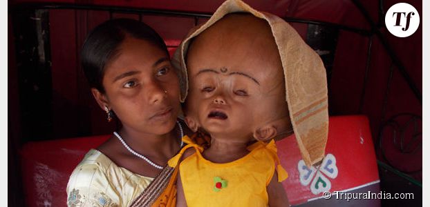 Roona Begum, la fillette indienne hydrocéphale, opérée avec succès