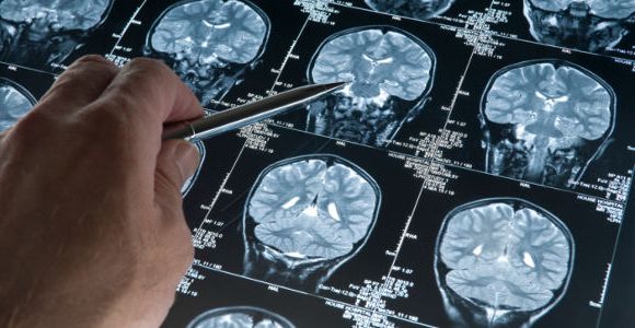 Alzheimer : quels sont les premiers symptômes de la maladie ?