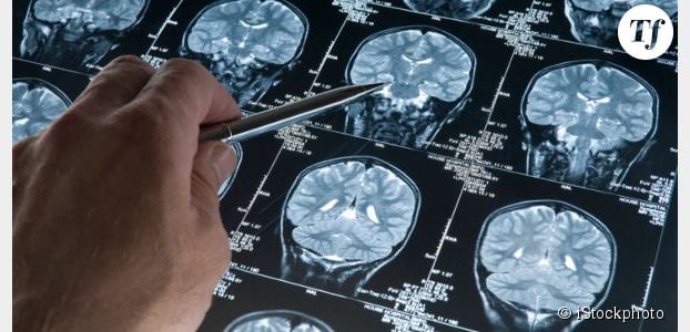 Alzheimer : quels sont les premiers symptômes de la maladie ?