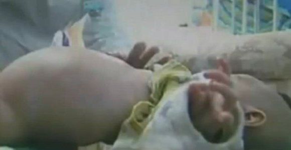 À deux ans, il accouche de son jumeau parasite - vidéo