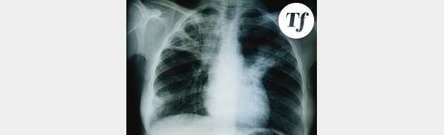 Tuberculose : découverte d'une enzyme responsable de la destruction des poumons