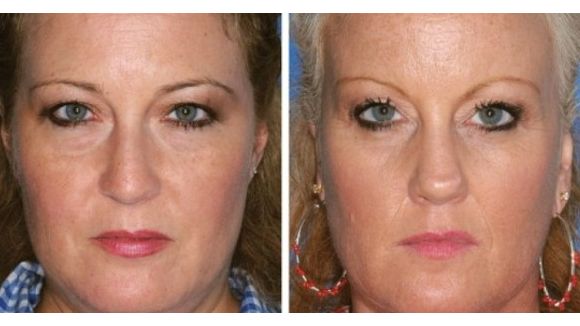 Tabac : ses ravages sur le visage prouvés grâce à des jumeaux