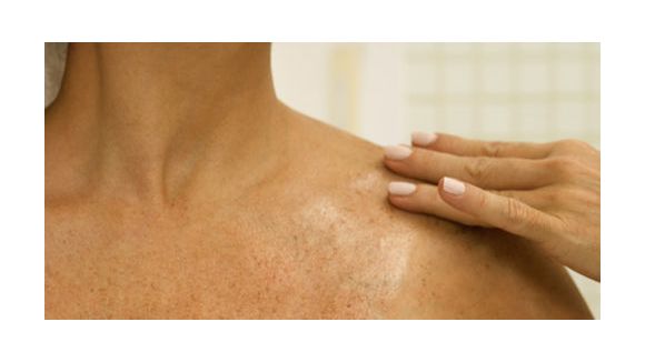 Cancer de la peau : Faites-vous dépister !