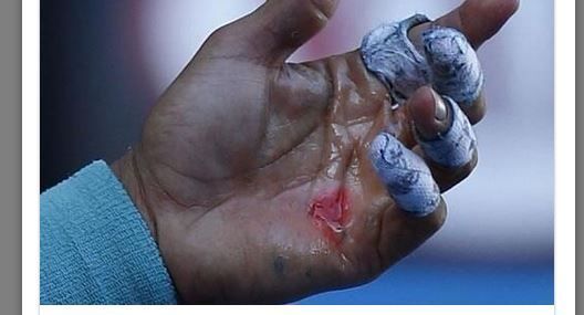 Open Australie 2014 : une ampoule sur la main de Nadal fait le buzz