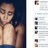 Shy'm dévoile de vilaines blessures sur Instagram 