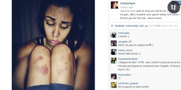 Shy'm dévoile de vilaines blessures sur Instagram