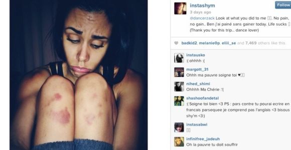 Shy'm dévoile de vilaines blessures sur Instagram 