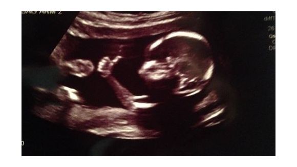 Un foetus fait le buzz dans le ventre de sa maman