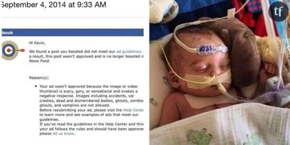 Facebook interdit la photo d’un bébé malade jugée "effrayante"