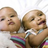 Deux fillettes siamoises séparées