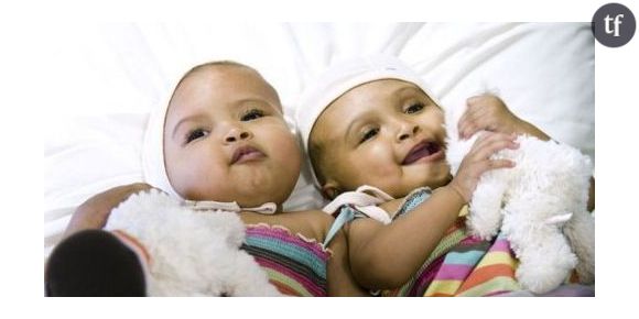 Deux fillettes siamoises séparées