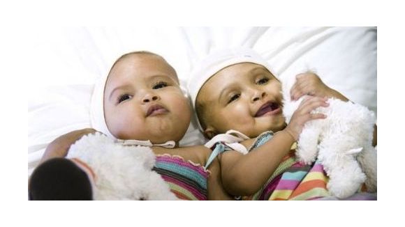 Deux fillettes siamoises séparées