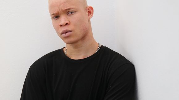 Menacé de mort en Sierra Leone, ce jeune albinos devient top model