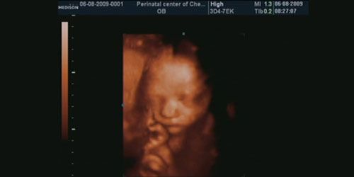 Echographies 3D : dangereuses et sans intérêt médical