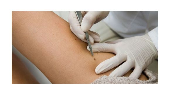 Cancer de la peau : un médicament pour traiter les cancers avancés