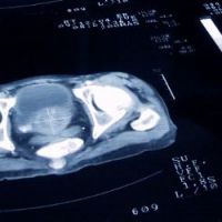 Moins de morts dues aux cancers en 2012