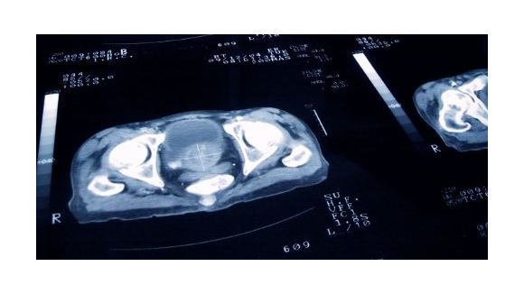 Moins de morts dues aux cancers en 2012