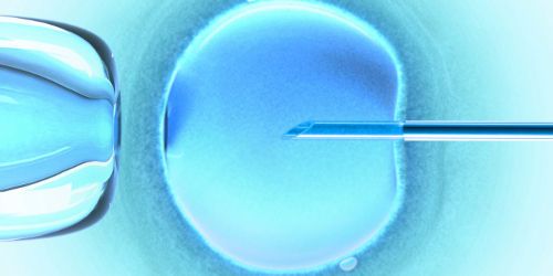 AMP : malformations plus fréquentes chez les bébés