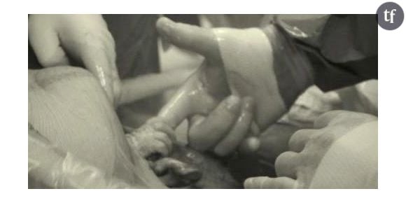 Un bébé serre le doigt d'un chirurgien avant d'être sorti du ventre de sa mère