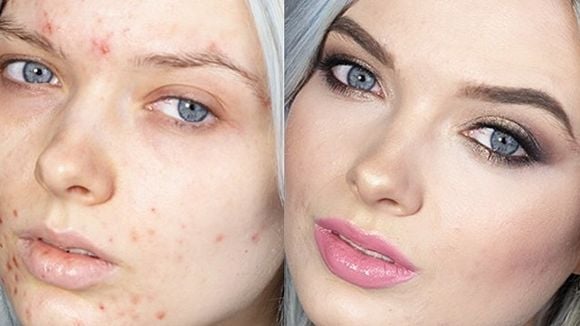 Insultée parce qu'elle a de l'acné, cette blogueuse beauté réplique avec force
