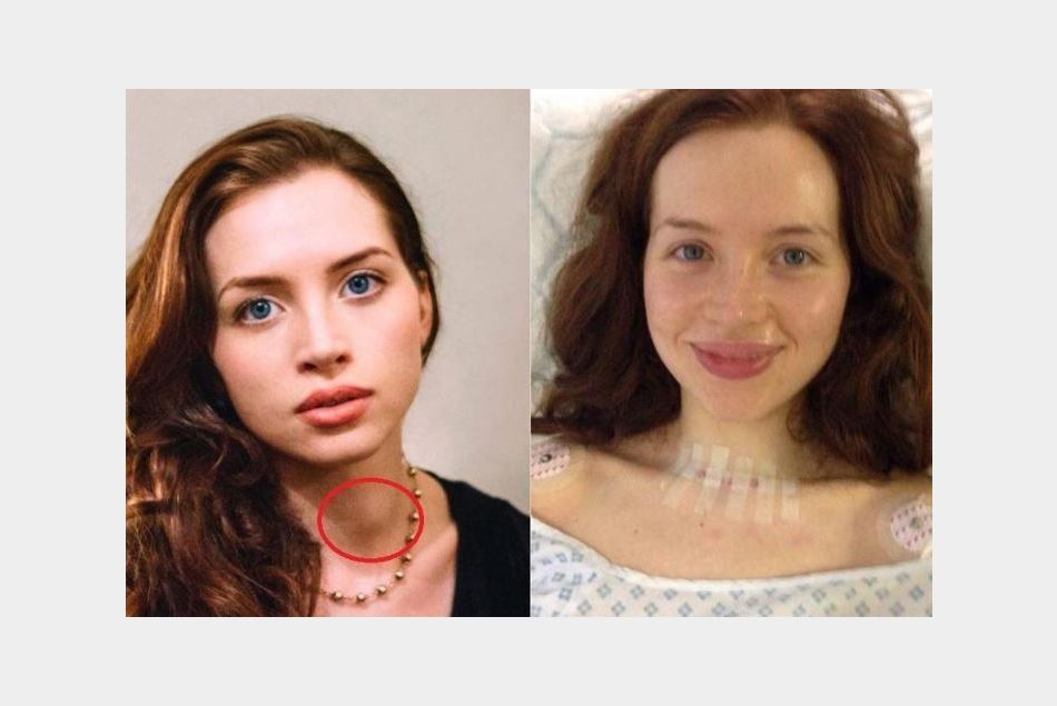 Les photo avant/après son opération de la thyroïde