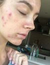  Madeleine Edwards dévoile son acné  
  