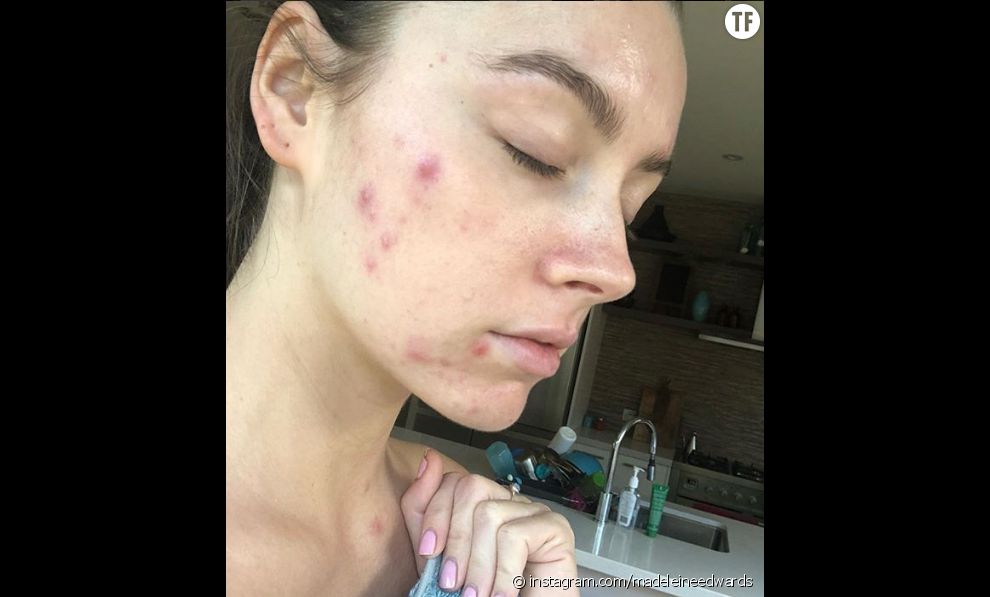 Madeleine Edwards dévoile son acné  
  