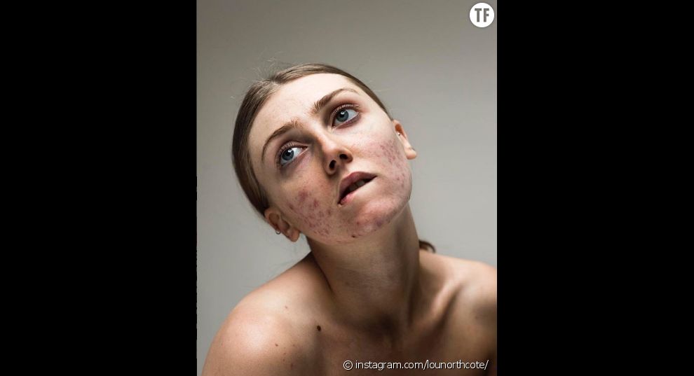 Louisa Northcote dévoile son acné