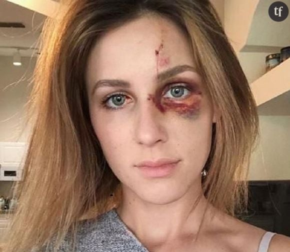 Battue par son compagnon, elle publie une photo de son visage tuméfié 