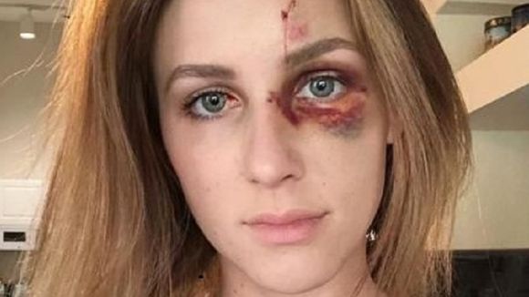 Battue par son compagnon, elle publie une photo de son visage tuméfié