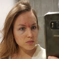 Triturer sa peau pour se "soulager" : Camille milite pour faire connaître la dermatillomanie