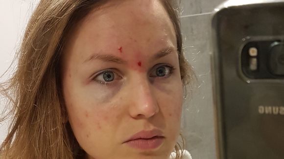 Triturer sa peau pour se "soulager" : Camille milite pour faire connaître la dermatillomanie