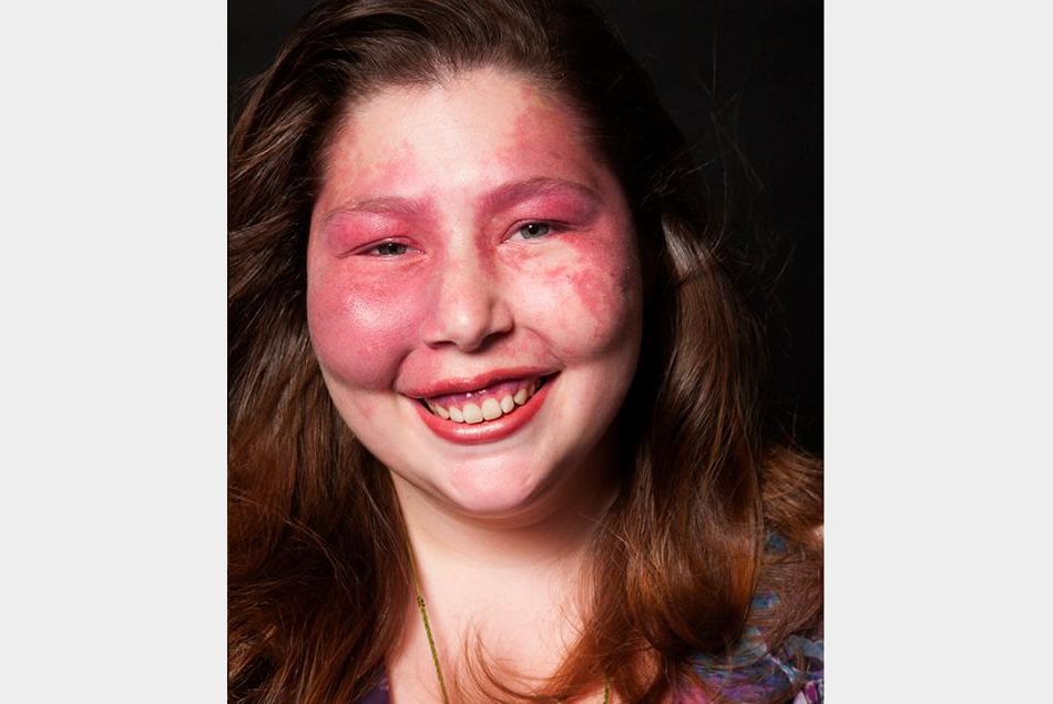Sarah Kanney, atteinte du syndrome de Sturge-Weber.