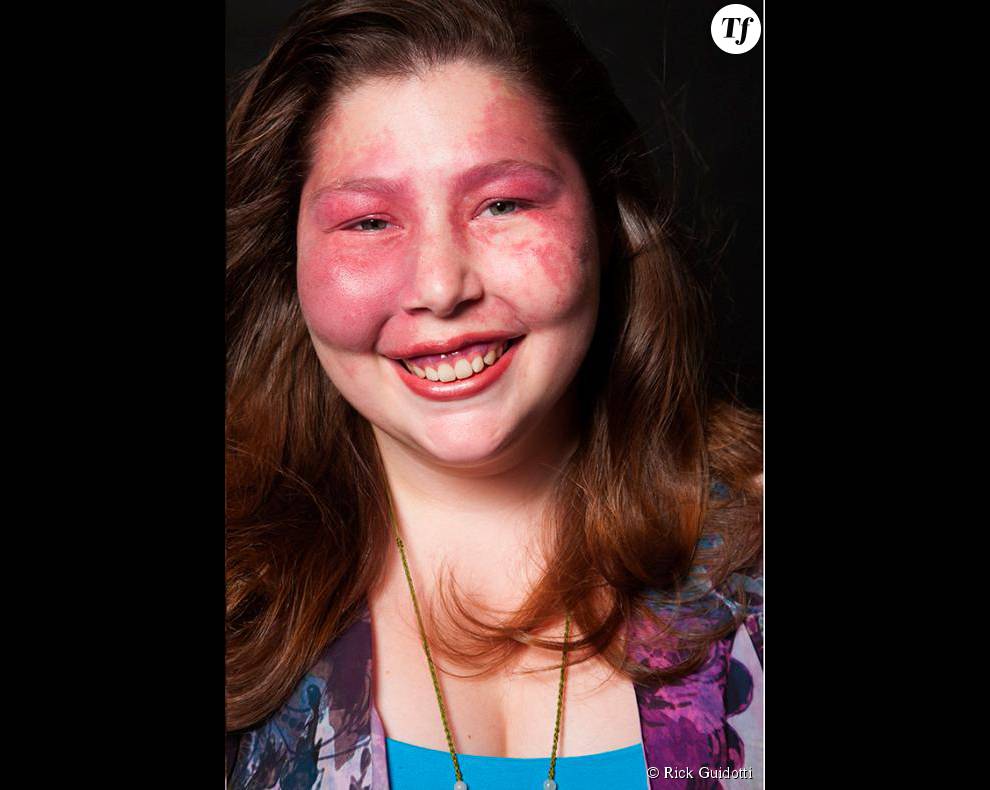 Sarah Kanney, atteinte du syndrome de Sturge-Weber.