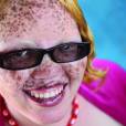 Jayne Waithera, atteinte d'albinisme.