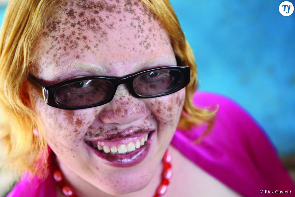 Jayne Waithera, atteinte d&#039;albinisme.