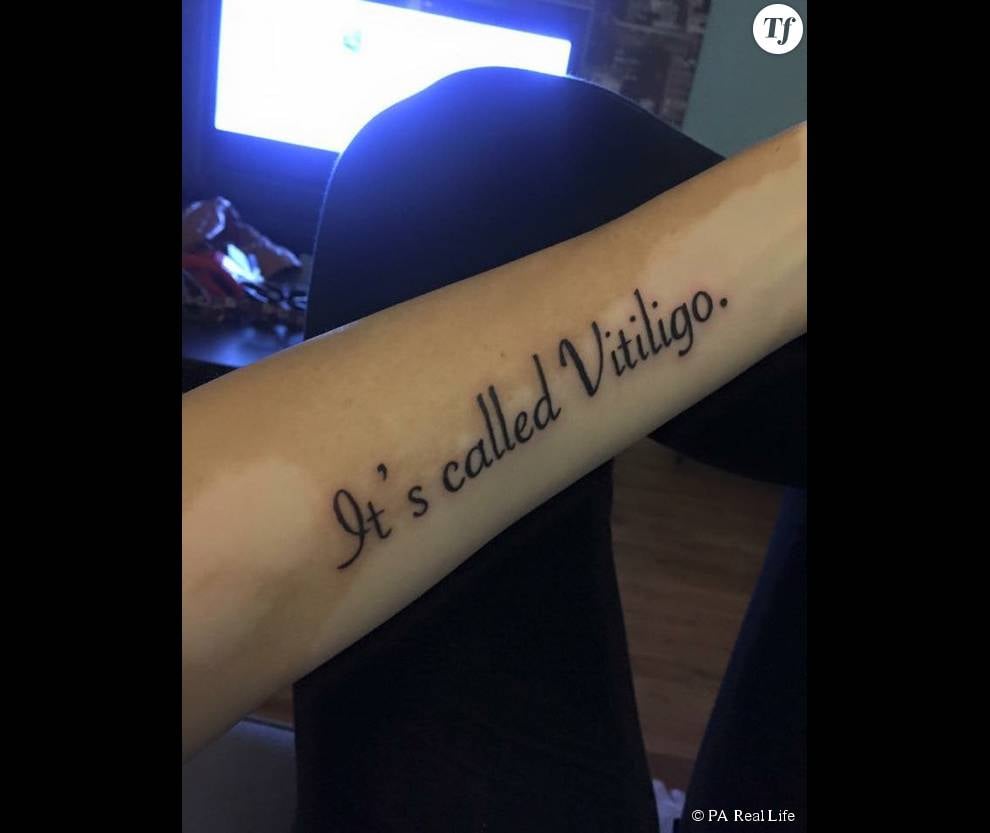 Et elle a décidé de marquer le coup avec un tatouage qui dit &quot;Ça s&#039;appelle le vitiligo&quot;.