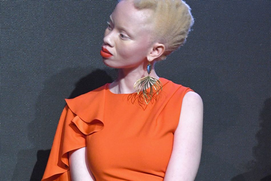 Ces mannequins et activistes atteintes d'albinisme qui défient la norme.