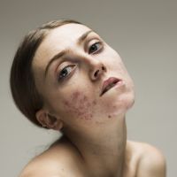 Acné, hyperpigmentation : cette photographe magnifie la peau et ses imperfections